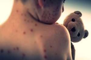 Measles-outbreak-in-Texas-USA-more-than-560-cases-reported