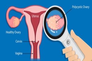 PCOS-can-also-affect-womens-brains-Study