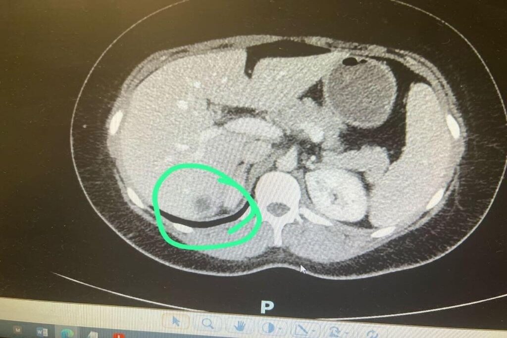महिला के लिवर में मिली 12 सप्ताह की गर्भावस्था, भारत का पहला अनोखा केस !