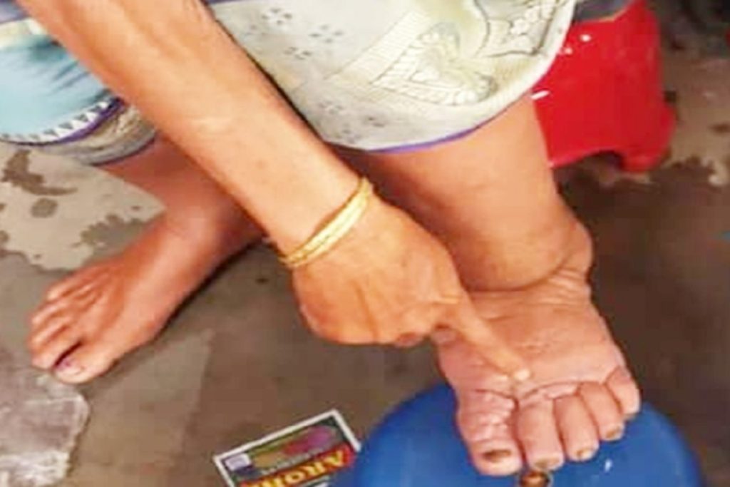 योगी सरकार का लक्ष्य 2027 तक ‘फाइलेरिया मुक्त उत्तर प्रदेश’, अभियान शुरू!