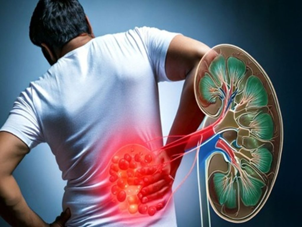 युवाओं में बढ़ रही किडनी स्टोन की समस्या, जीवनशैली सही कर पा सकते हैं निदान