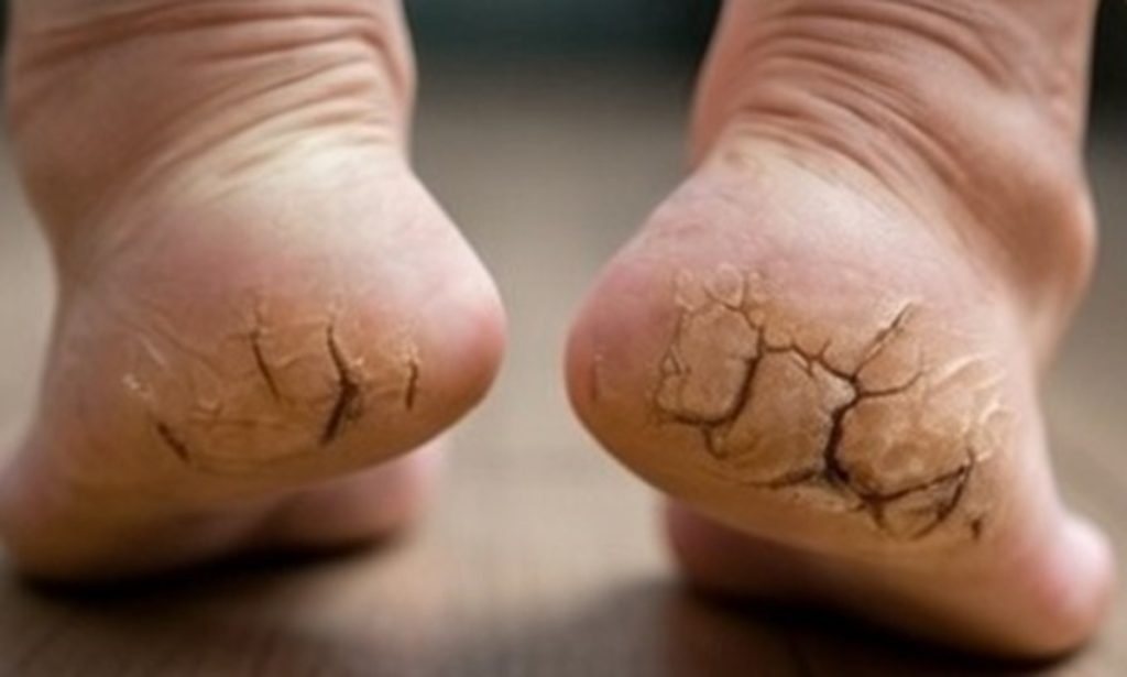 फिर से बन सकती हैं मुलायम फटी एड़ियां बस करना है यह आयुर्वेदिक उपाय